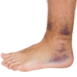 Bruised Ankle